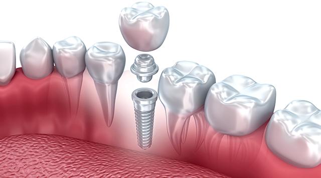 Kako odabrati zubni Implantat?