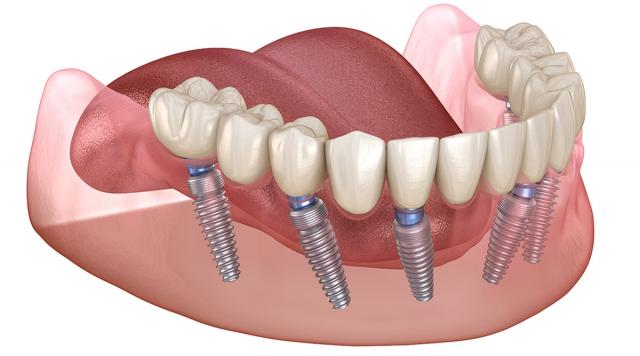 Procedura terapije All-on-6