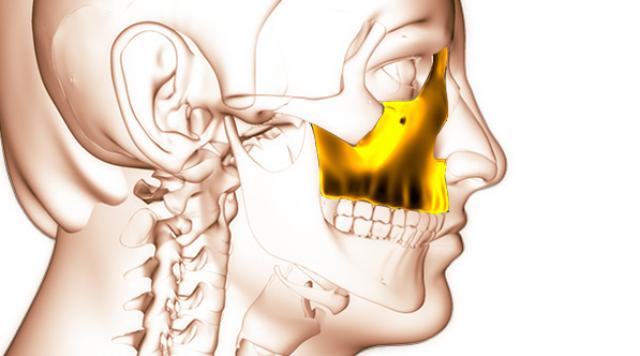 Zigomatični Implantati